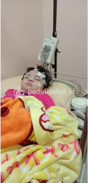 Tak Miliki Biaya, Alisha Anak Penderita Radang Otak Butuh Uluran Tangan