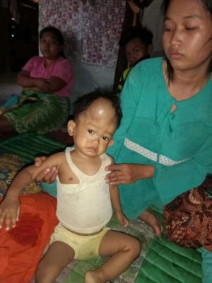Bayi Satu Tahun Menderita Tumor di Keningnya Butuh Uluran Tangan