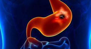 Kenali Ragam Penyakit Lambung dan Sebabnya 